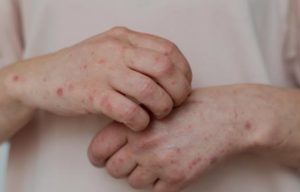 Kenali Gejala Flu Singapur Yang Lagi Marak Di Lampung
