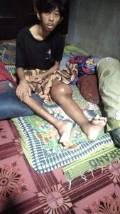 Pelajar SMAN 1 Kota Agung Tanggamus Divonis Kanker, Keluarga Kurang Mampu Butuh Bantuan